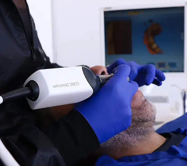 Dentista de quillota trabajando en tratamiento de Carillas coronas incrustaciones con sistema Cerec